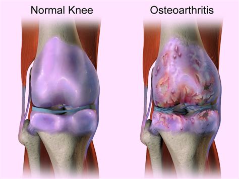 What is Osteoarthritis ? - OrthoJointRelief