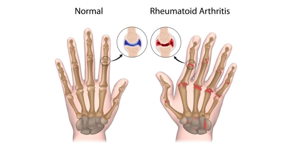 What is Rheumatoid Arthritis ? - OrthoJointRelief