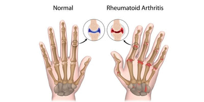 What is Rheumatoid Arthritis ?